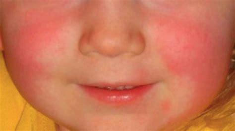 güneş alerjisi yüz kızarması